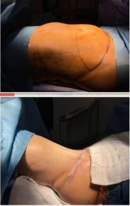 Abdominoplasty