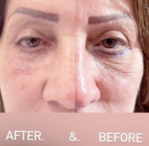 Blepharoplasty