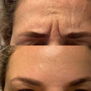 Botox
