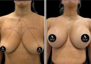 Breast Augmentation