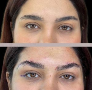 Browlift