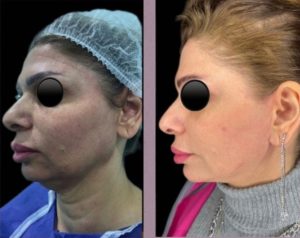 Facelift