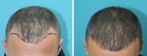 Hair Transplant
