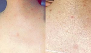Hair Removing Laser