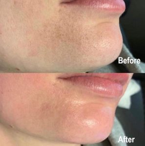 Hydrafacial