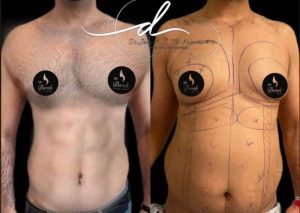 Liposuction