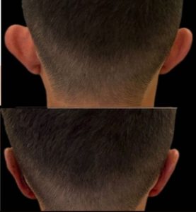 Otoplasty