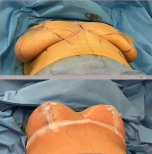 Reduction mammoplasty