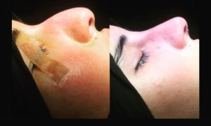 Rhinoplasty